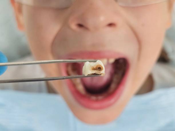 Best Emergency Wisdom Tooth Extraction in Odessa, MO